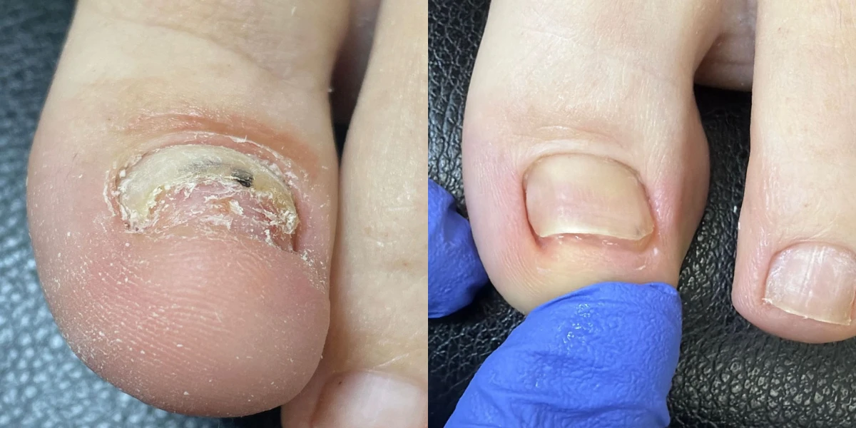 Medi Pedicure