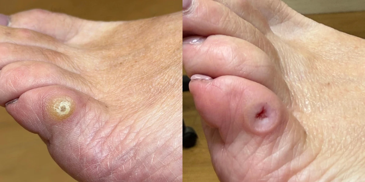 Medi Pedicure