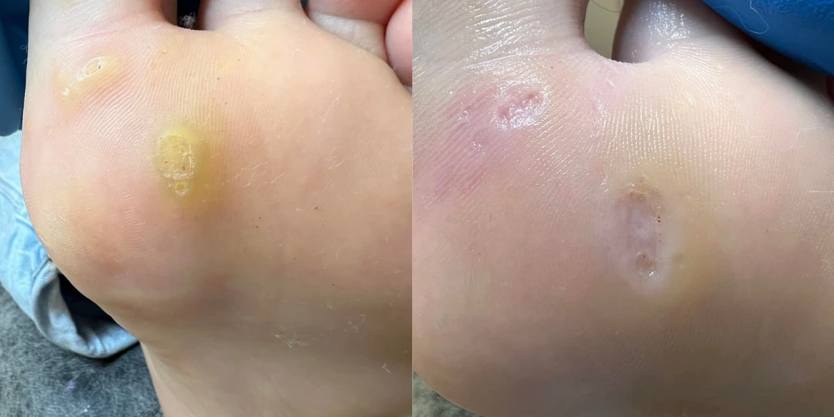Medi Pedicure