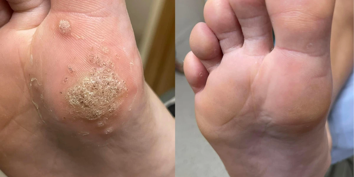 Medi Pedicure