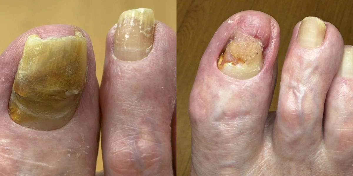 Medi Pedicure